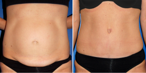 Reclaim Your Pre-Pregnancy Body: Tummy Tuck After Pregnancy - Peninsula  Plastic Surgery