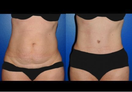 Tummy Tuck Before & After Syracuse