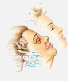 facelift surgery syracuse ny