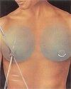 Male Breast Reduction