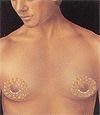 Male Breast Reduction