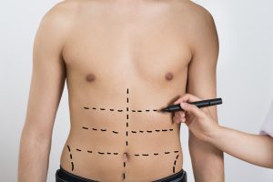 Liposuction for Men Syracuse, NY