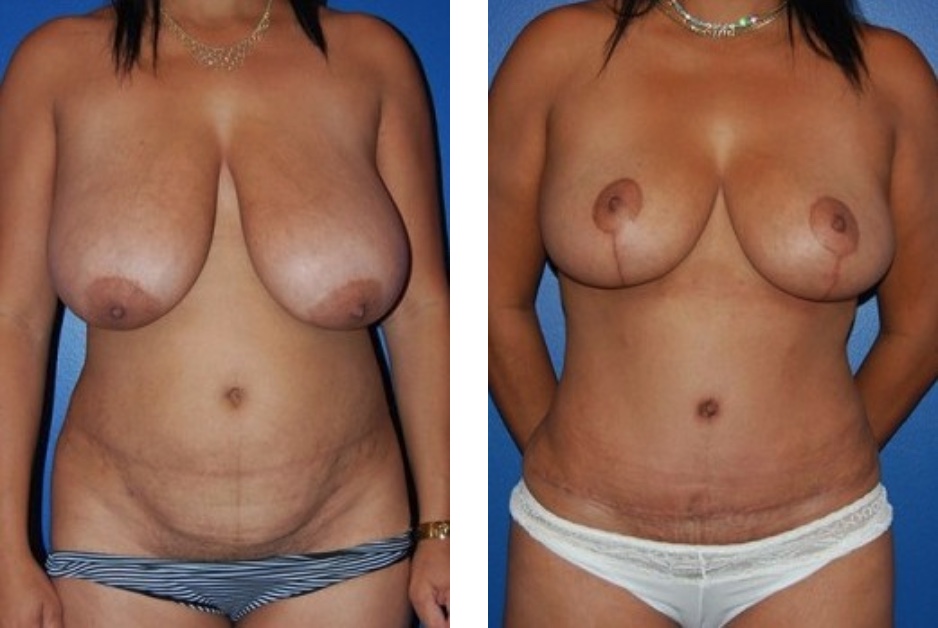 Before and After Mommy Makeover | DeRoberts Plastic Surgery | Syracuse, NY