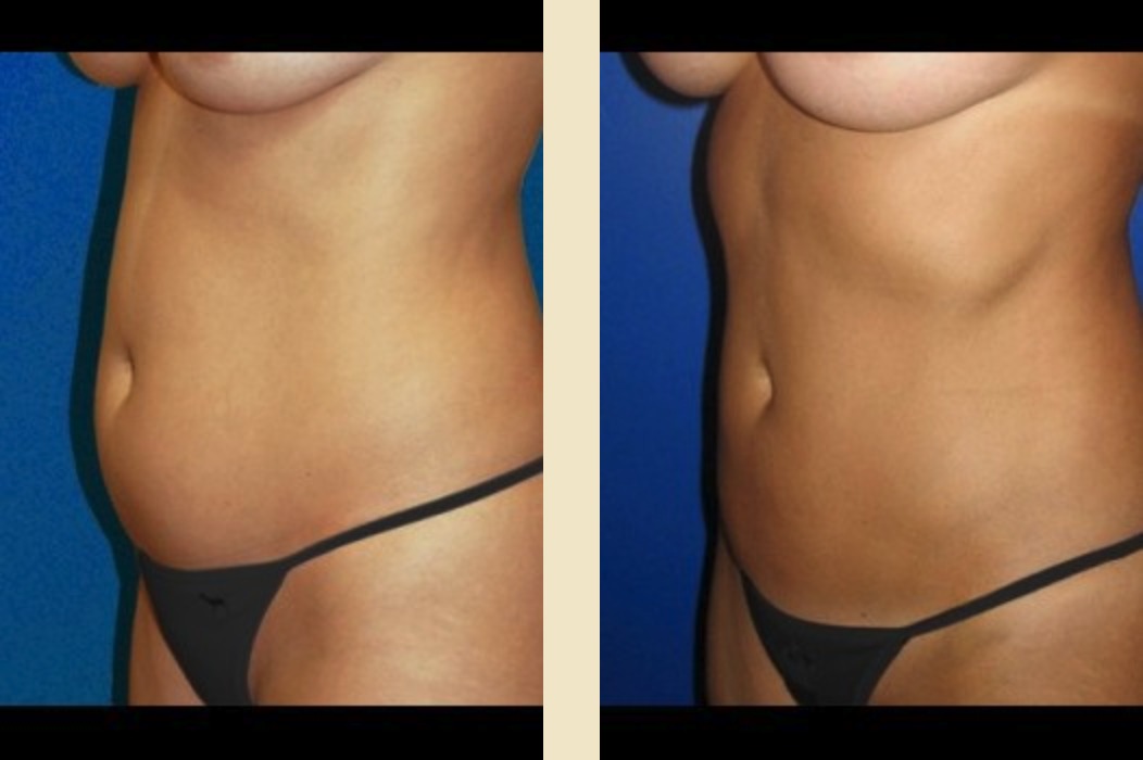 Liposuction & Body Contouring in Syracuse, NY: Syracuse Plastic Surgery