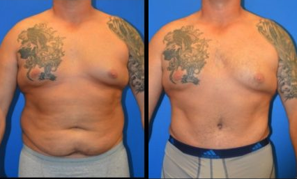 Male Tummy Tuck Before & After