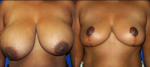 Breast Reduction Before & After