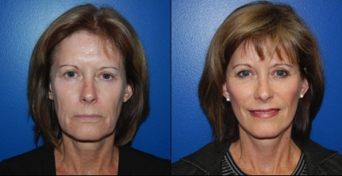 Facelift Before & After