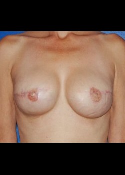 After-BreastReconstruction