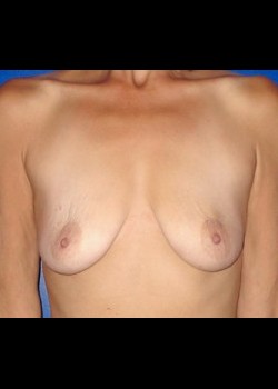 Before-BreastReconstruction