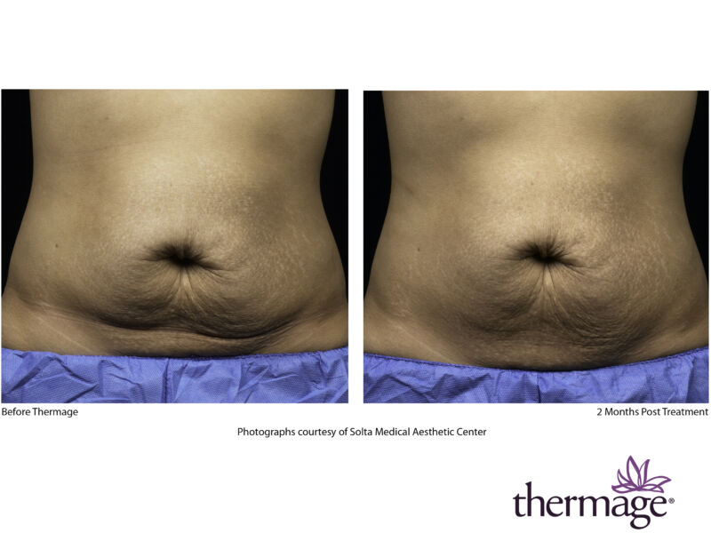 Laser Hair Removal Syracuse, Hair Reduction Watertown, Utica