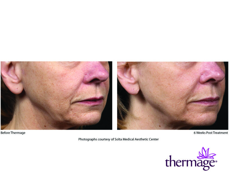 Laser Hair Removal Syracuse, Hair Reduction Watertown, Utica