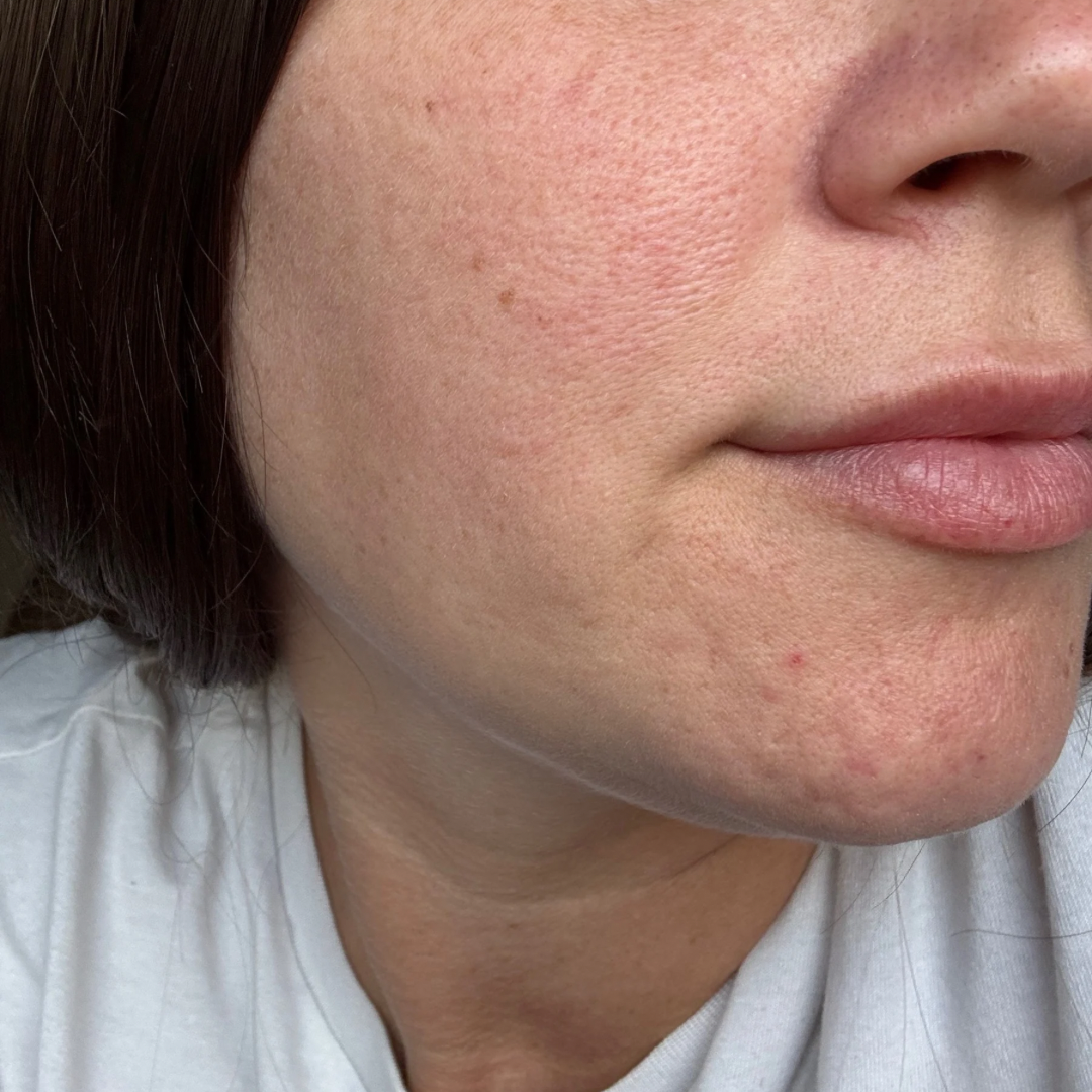Amanda MORPHEUS8 Resurfacing – 3