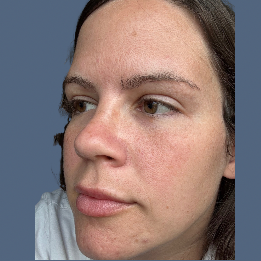 Amanda MORPHEUS8 Resurfacing – 5