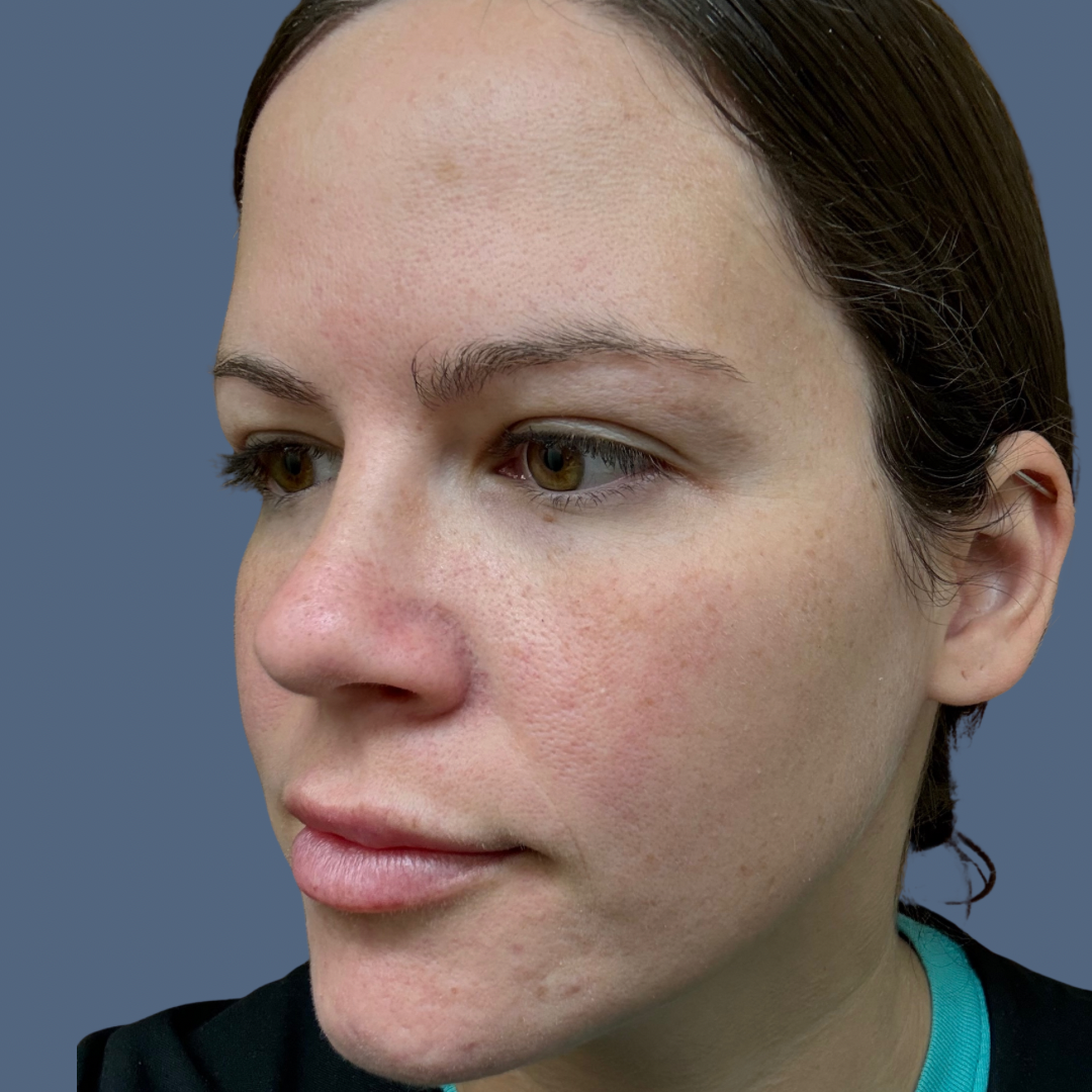 Amanda MORPHEUS8 Resurfacing – 6